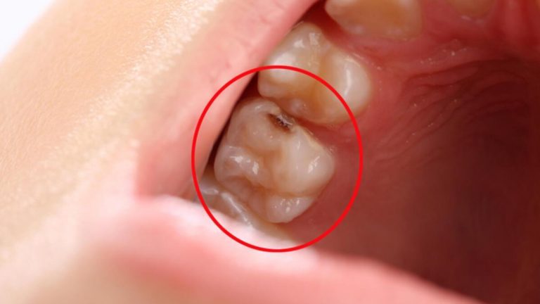 Bu yağ çürük diş ağrısına iyi geliyor! Çürük Diş Ağrısına Ne İyi Gelir, Nasıl Geçer? Diş Çürüğü Ağrısı Evde Tedavi Edilir Mi?